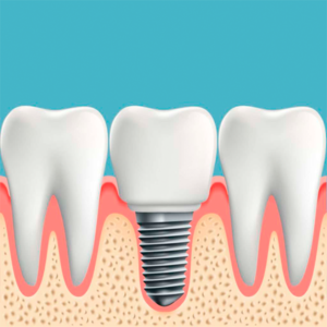 implante dental osasco SP